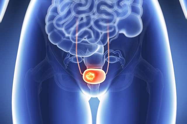 3d rendered illustration - bladder cancer